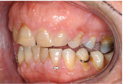 【病案】牙龈增生作为肉芽肿性血管炎复发的第一迹象