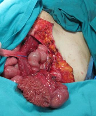 通过之前剖宫产在下腹中线留下的瘢痕进入腹腔.