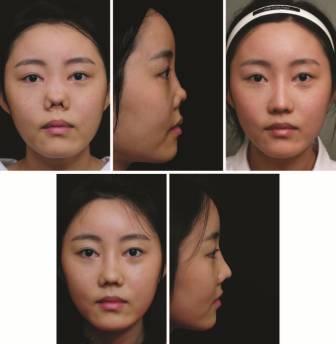 垫鼻子需要多少钱