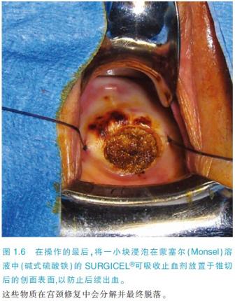 【前沿】妇科肿瘤手术规避失误实用操作之"宫颈冷刀椎