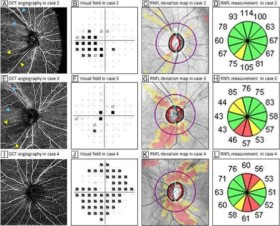 病案视觉光学相干断层扫描在青光眼诊疗中作用显著