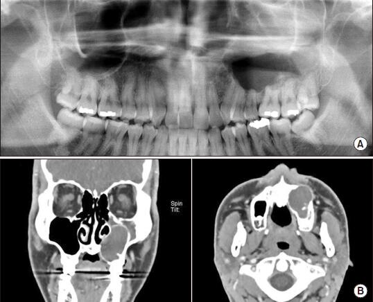 【病案】复发性牙源性钙化囊性瘤上颌窦占位
