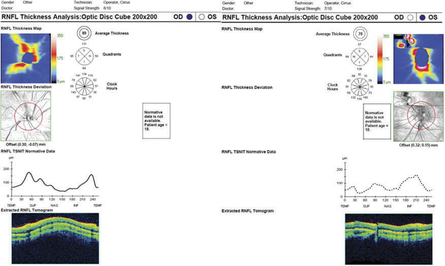 光学相干断层扫描(oct)黄斑检查是正常的,双眼视网膜神经纤维层(rnfl)