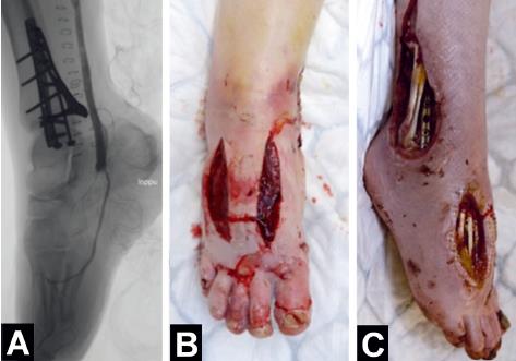 【病案】踝部骨折后外侧内固定术后需行截肢术