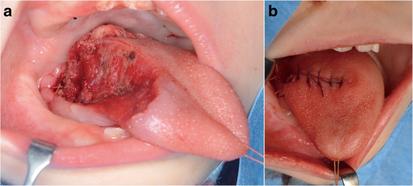 全身麻醉下进行局部皮瓣切除至5mm安全缘,同时重建舌部切除术后.
