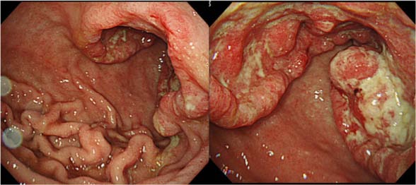 术前内镜检查发现胃窦胃小弯处有3型胃癌和幽门梗阻